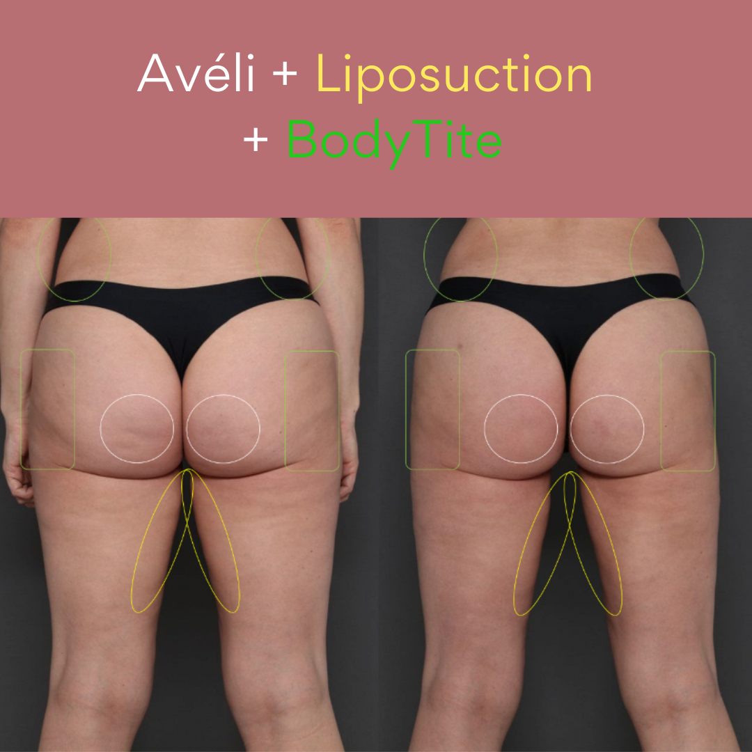 Avéli™ + Liposuction + BodyTite.