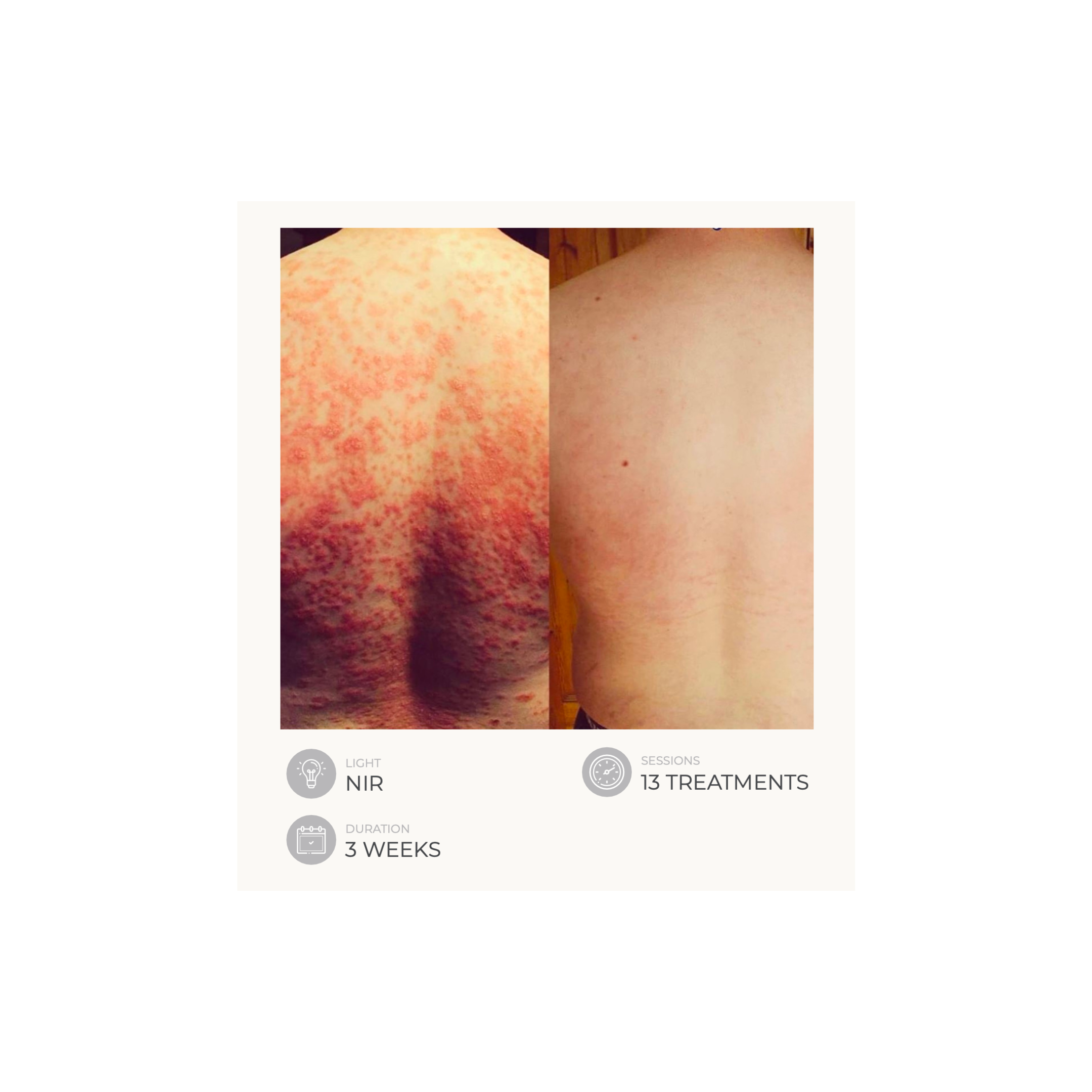 Dermalux Flex MD - Medical Grade LED Light Therapy Device