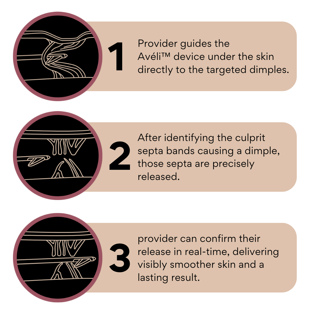 Provider guides the Avéli™ device under the skin directly to the targeted dimples. After identifying the culprit septa bands causing a dimple, those septa are precisely released. Provider can confirm release in real-time, delivering visibly smoother skin and a lasting result.
