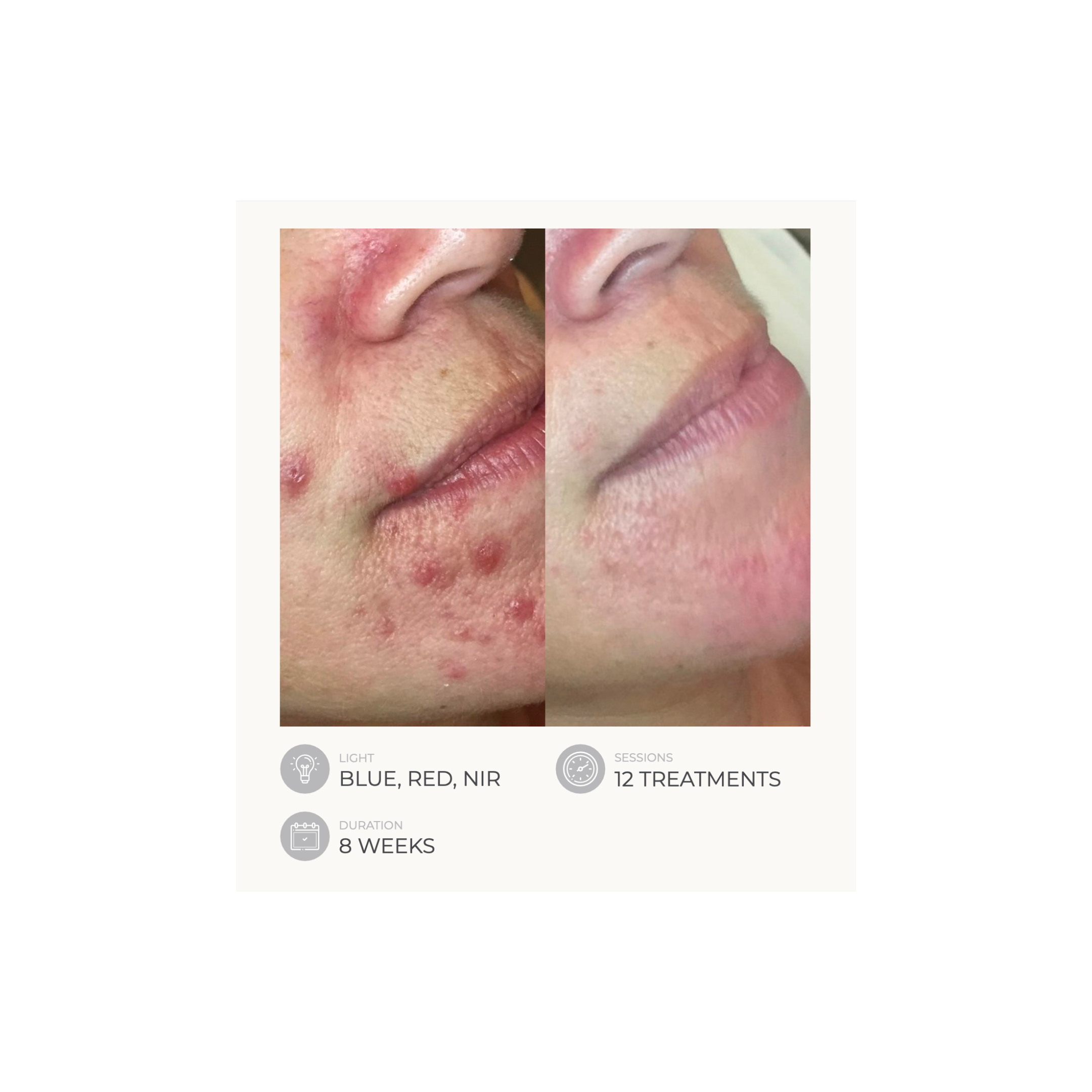 Dermalux Flex MD - Medical Grade LED Light Therapy Device