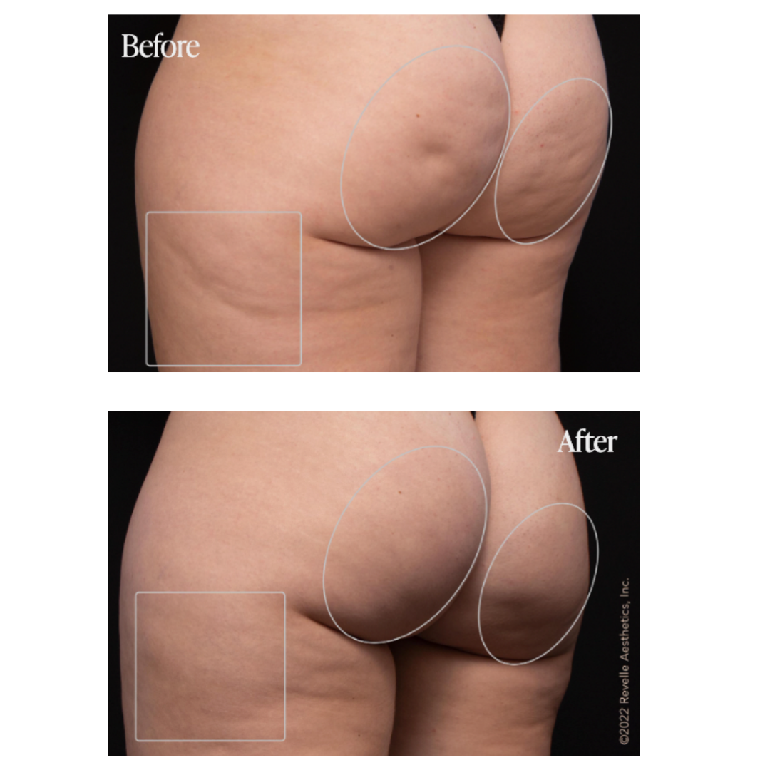 Avéli™ cellulite reduction before and after.