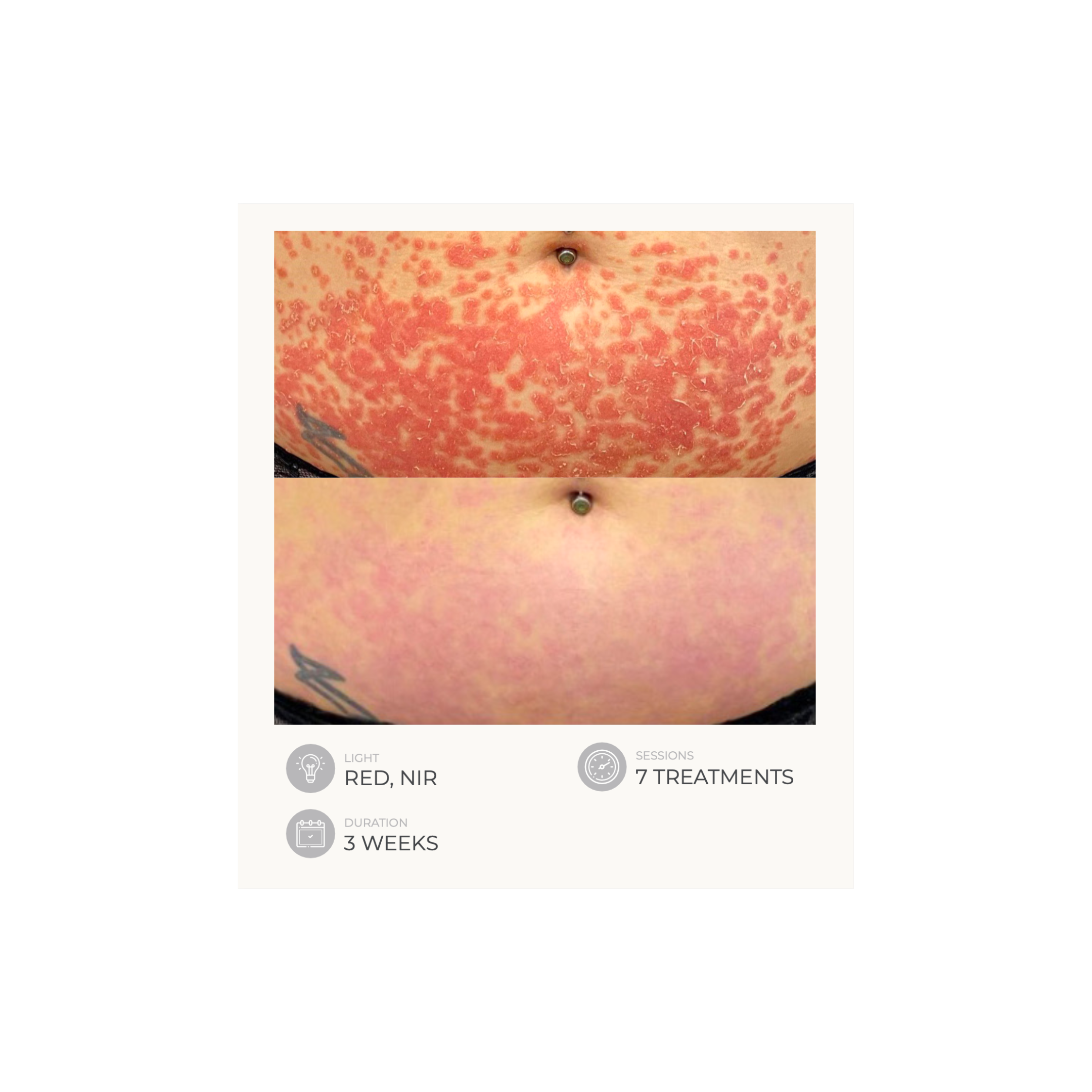 Dermalux Flex MD - Medical Grade LED Light Therapy Device