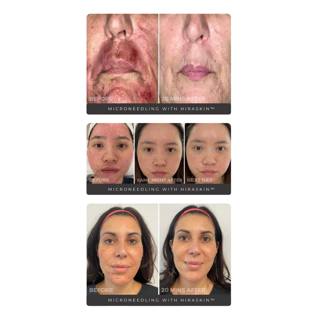 HIRASKIN™ Second Skin Collagen Masks (50)