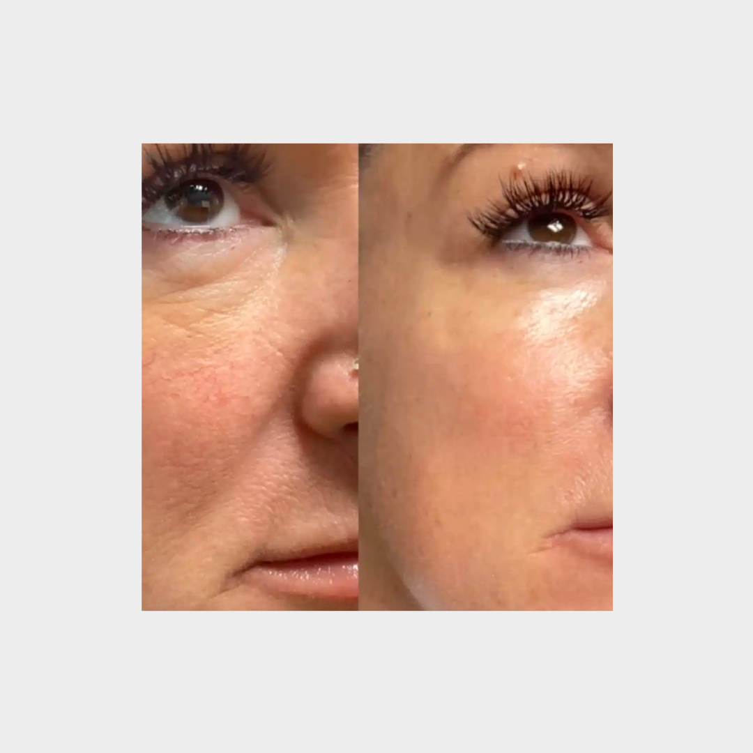 PDO Max Threads – Premium Lifting & Rejuvenation Solutions